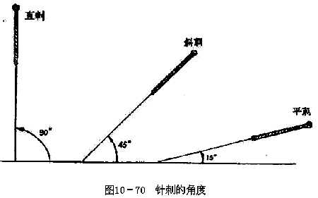 针刺的角度