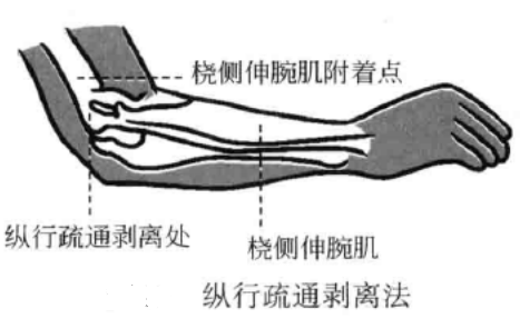 纵行疏通剥离法