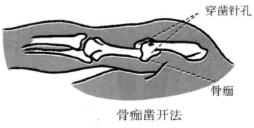骨痂凿开法