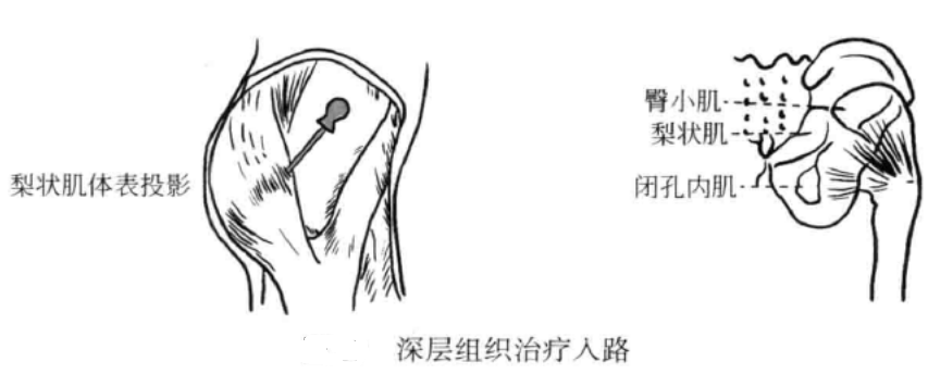 深层组织治疗入路