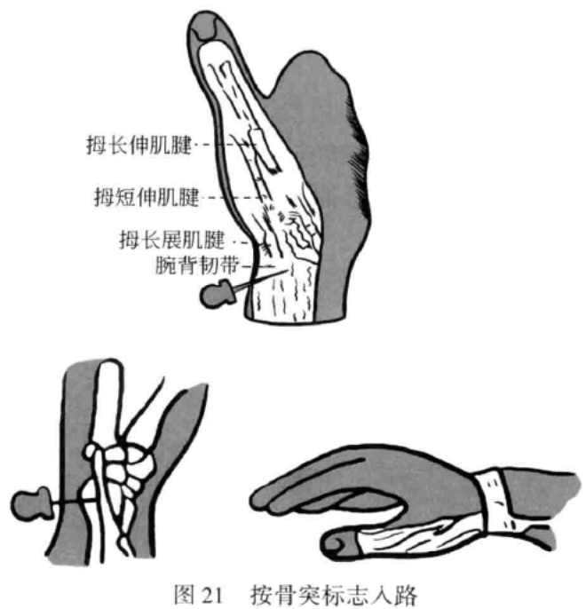 按骨突标志入路