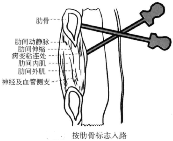 按肋骨标志入路