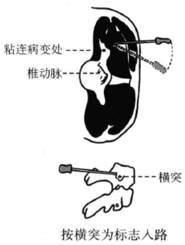 按横突为标志入路