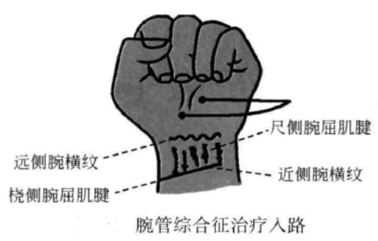 腕管综合征治疗入路