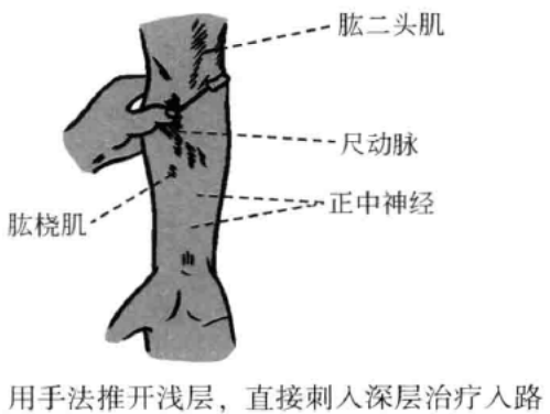 用手法惟开浅层,直接刺入深层治疗入路